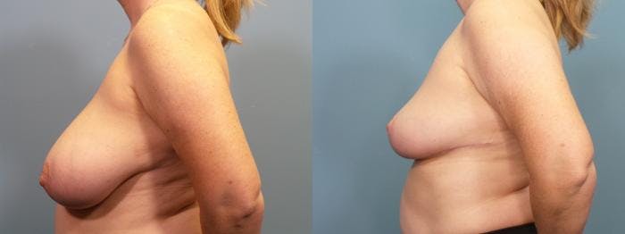 Breast Reduction Before & After Gallery - Patient 223918 - Image 3