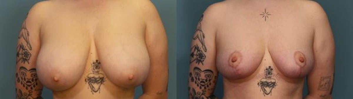 Breast Reduction Before & After Gallery - Patient 206299 - Image 1