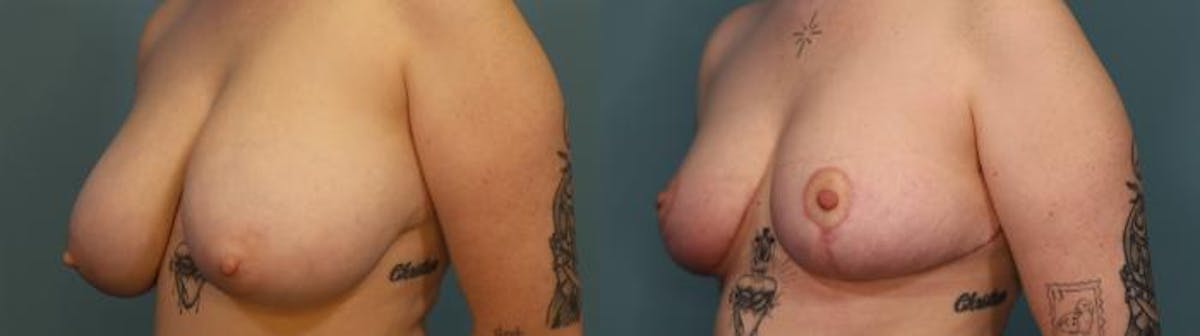Breast Reduction Before & After Gallery - Patient 206299 - Image 2