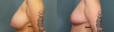 Breast Reduction Before & After Gallery - Patient 206299 - Image 3