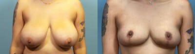 Breast Reduction Before & After Gallery - Patient 348570 - Image 1