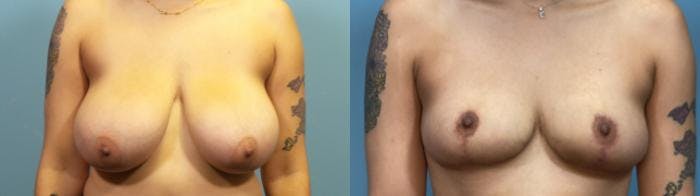 Breast Reduction Before & After Gallery - Patient 348570 - Image 1