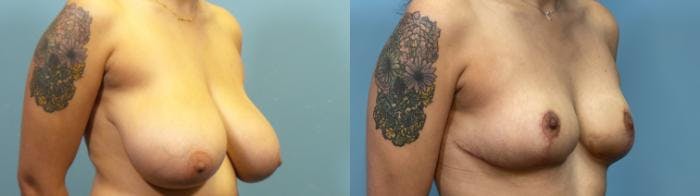 Breast Reduction Before & After Gallery - Patient 348570 - Image 2