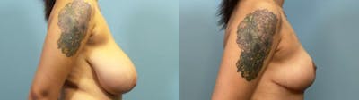 Breast Reduction Before & After Gallery - Patient 348570 - Image 3