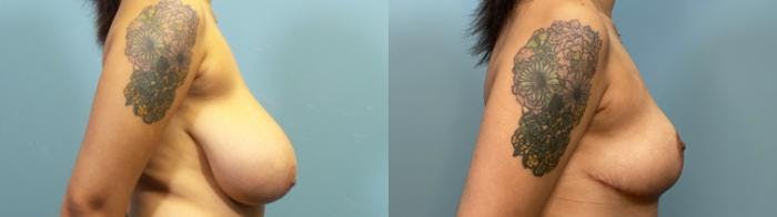 Breast Reduction Before & After Gallery - Patient 348570 - Image 3