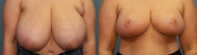 Breast Reduction Before & After Gallery - Patient 313388 - Image 1
