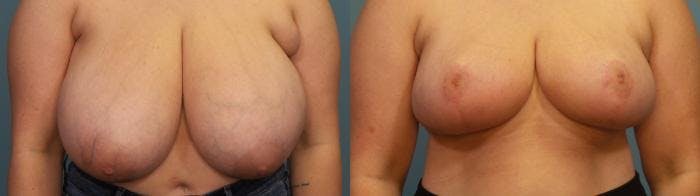 Breast Reduction Before & After Gallery - Patient 313388 - Image 1