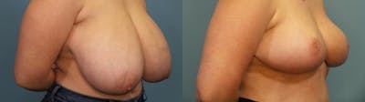 Breast Reduction Before & After Gallery - Patient 313388 - Image 2