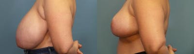 Breast Reduction Before & After Gallery - Patient 313388 - Image 3