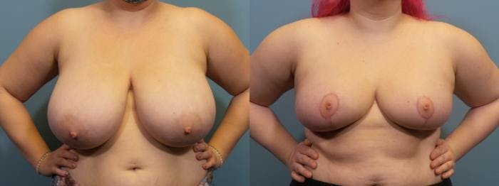 Breast Reduction Before & After Gallery - Patient 619658 - Image 1