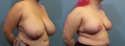 Breast Reduction Before & After Gallery - Patient 619658 - Image 2