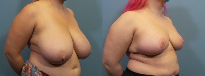 Breast Reduction Before & After Gallery - Patient 619658 - Image 2