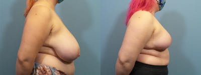 Breast Reduction Before & After Gallery - Patient 619658 - Image 3