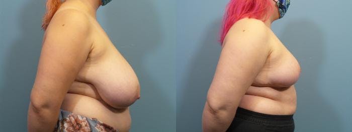 Breast Reduction Before & After Gallery - Patient 619658 - Image 3