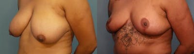 Breast Reduction Before & After Gallery - Patient 104740 - Image 2