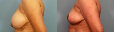 Breast Reduction Before & After Gallery - Patient 104740 - Image 3