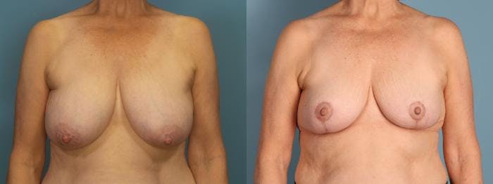 Breast Reduction Before & After Gallery - Patient 120382 - Image 1