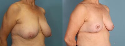 Breast Reduction Before & After Gallery - Patient 120382 - Image 2