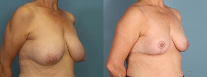 Breast Reduction Before & After Gallery - Patient 120382 - Image 2