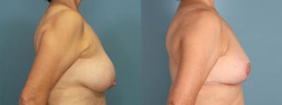 Breast Reduction Before & After Gallery - Patient 120382 - Image 3