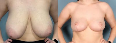 Breast Reduction Before & After Gallery - Patient 234793 - Image 1
