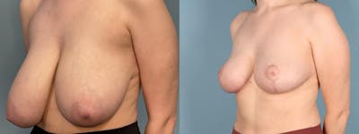 Breast Reduction Before & After Gallery - Patient 234793 - Image 2