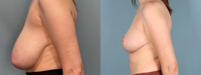 Breast Reduction Before & After Gallery - Patient 234793 - Image 3