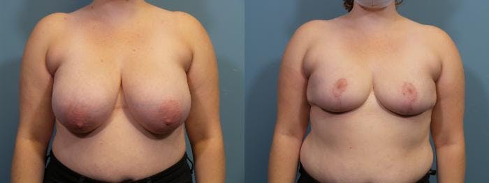 Breast Reduction Before & After Gallery - Patient 371774 - Image 1