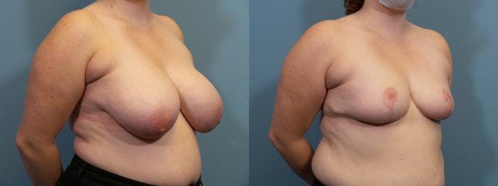 Breast Reduction Before & After Gallery - Patient 371774 - Image 2