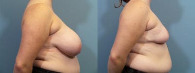 Breast Reduction Before & After Gallery - Patient 371774 - Image 3