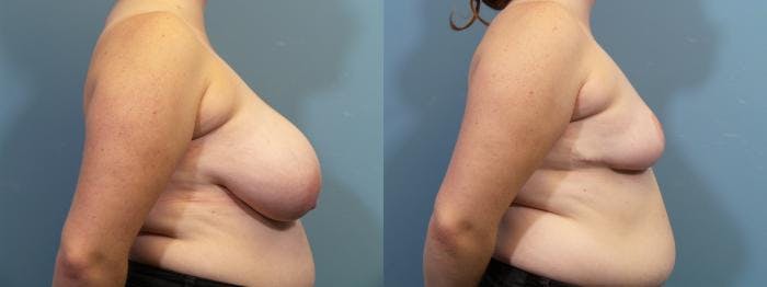 Breast Reduction Before & After Gallery - Patient 371774 - Image 3