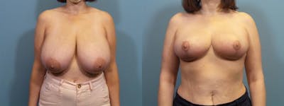 Breast Reduction Before & After Gallery - Patient 116544 - Image 1