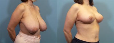 Breast Reduction Before & After Gallery - Patient 116544 - Image 2