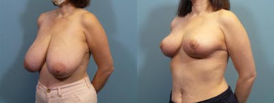 Breast Reduction Before & After Gallery - Patient 116544 - Image 3
