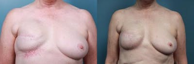 Breast Reconstruction Before & After Gallery - Patient 251817 - Image 1