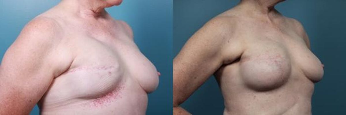 Breast Reconstruction Before & After Gallery - Patient 251817 - Image 2