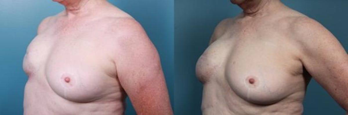 Breast Reconstruction Before & After Gallery - Patient 251817 - Image 3