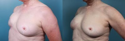 Breast Reconstruction Before & After Gallery - Patient 251817 - Image 3
