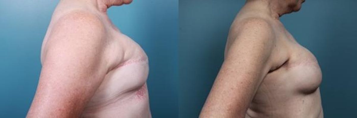 Breast Reconstruction Before & After Gallery - Patient 251817 - Image 4