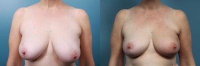 Breast Reconstruction Before & After Gallery - Patient 292005 - Image 1