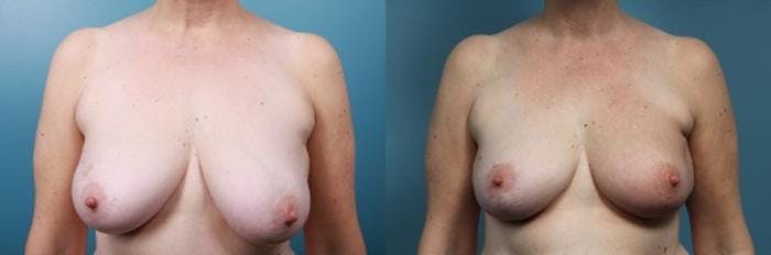 Breast Reconstruction Before & After Gallery - Patient 292005 - Image 1