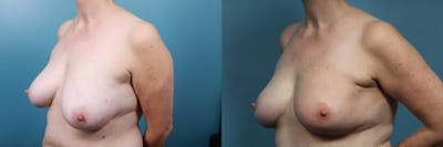 Breast Reconstruction Before & After Gallery - Patient 292005 - Image 2