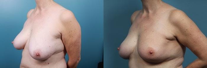 Breast Reconstruction Before & After Gallery - Patient 292005 - Image 2