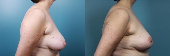 Breast Reconstruction Before & After Gallery - Patient 292005 - Image 3