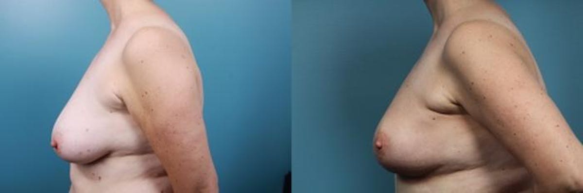 Breast Reconstruction Before & After Gallery - Patient 292005 - Image 4