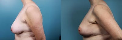 Breast Reconstruction Before & After Gallery - Patient 292005 - Image 4