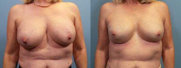 Breast Reconstruction Before & After Gallery - Patient 307881 - Image 1