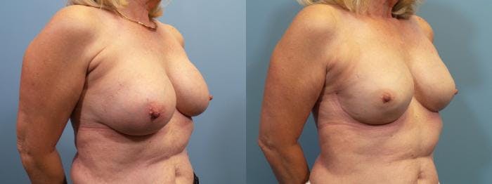 Breast Reconstruction Before & After Gallery - Patient 307881 - Image 2