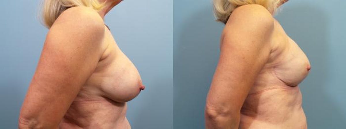 Breast Reconstruction Before & After Gallery - Patient 307881 - Image 3