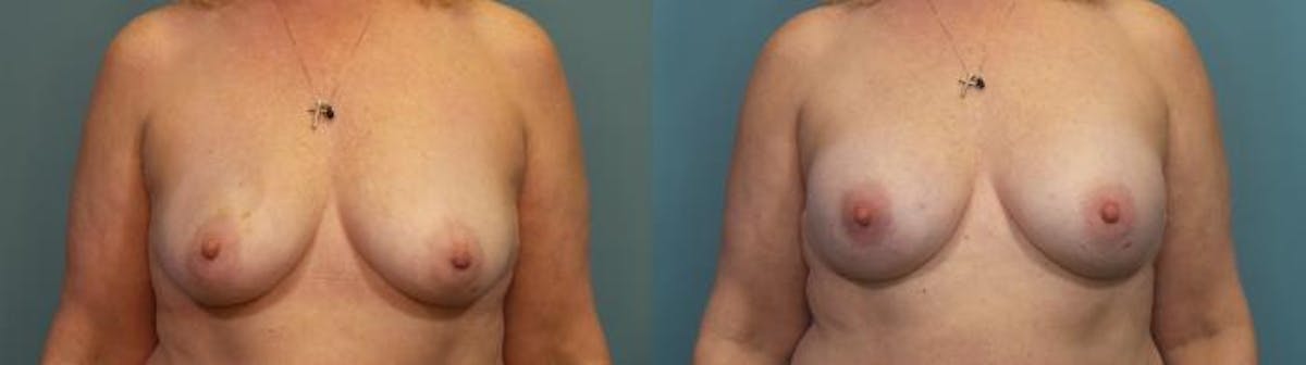 Breast Reconstruction Before & After Gallery - Patient 128533 - Image 1